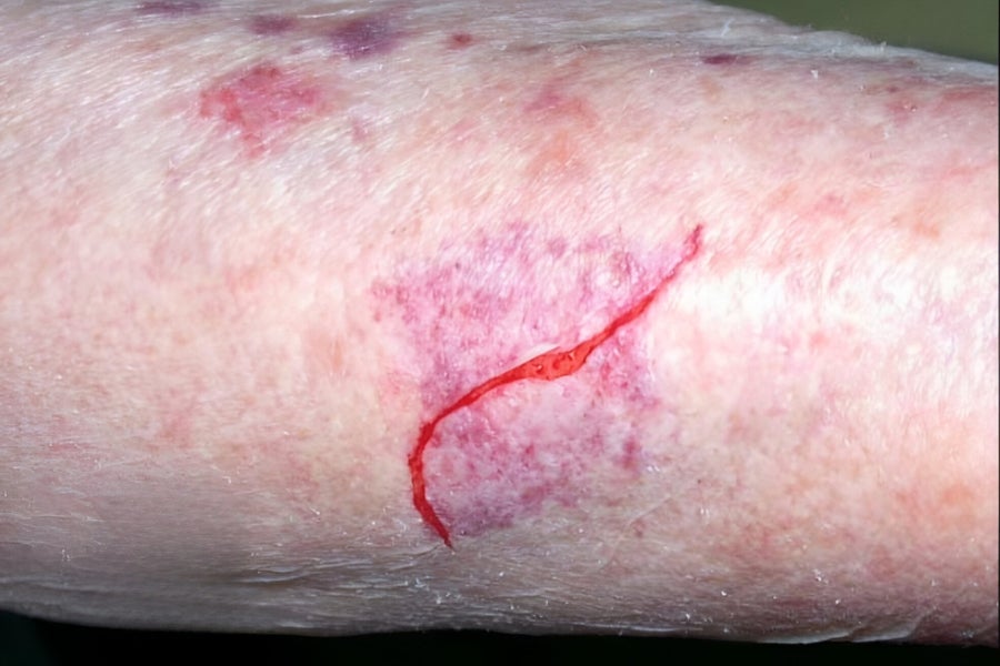 Image d'une peau très fine et abîmée, avec une déchirure