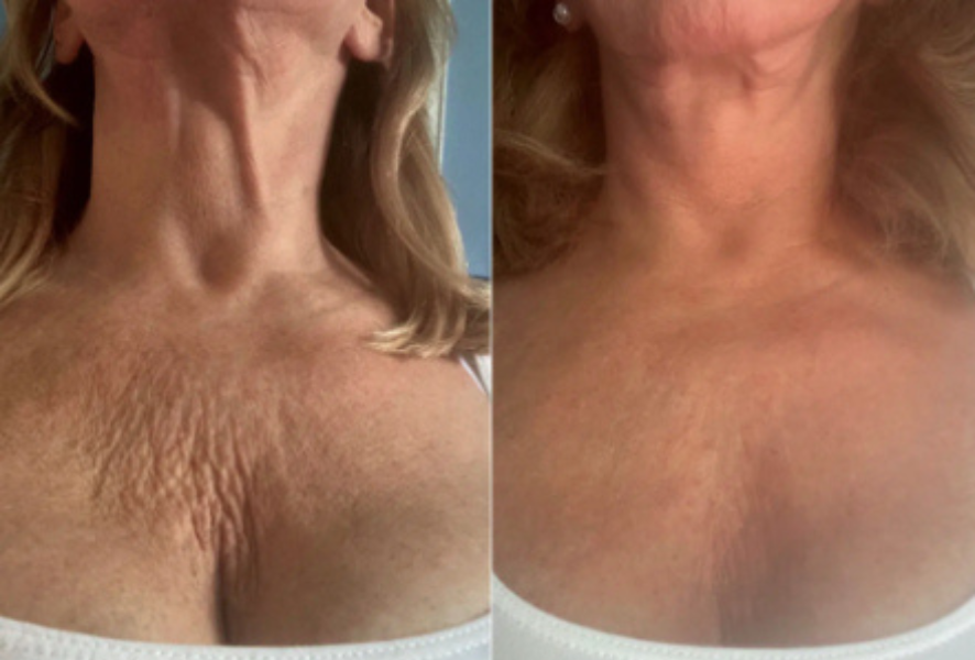 Résultat avant et après sur le décolleté
